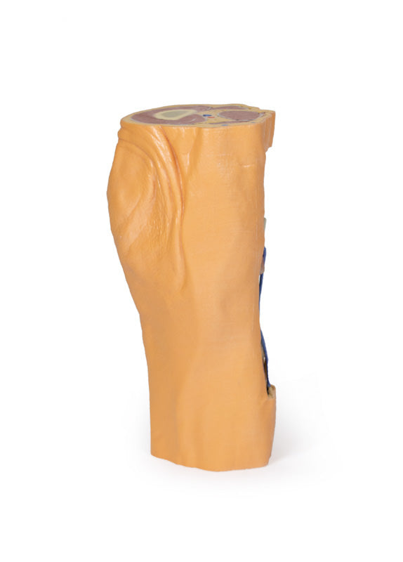 Popliteal Fossa distalt lår og proksimalt ben