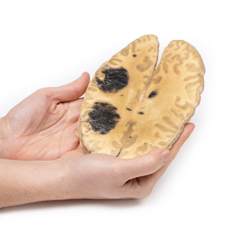 Cerebral blødning, sekundær til akut myeloid leukæmi