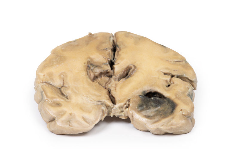 Glioblastoma multiforme
