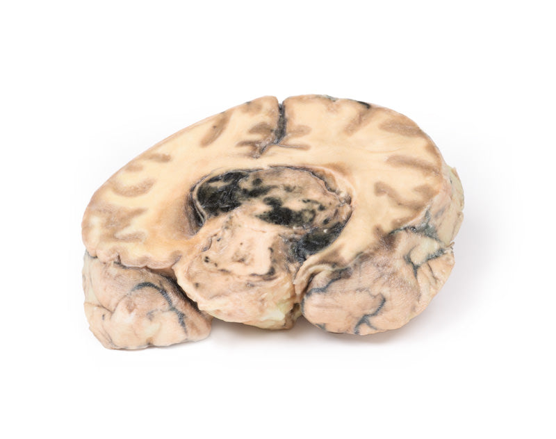 Glioblastoma multiforme