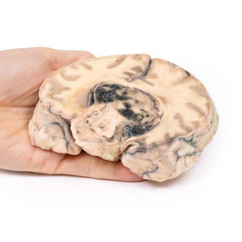 Glioblastoma multiforme