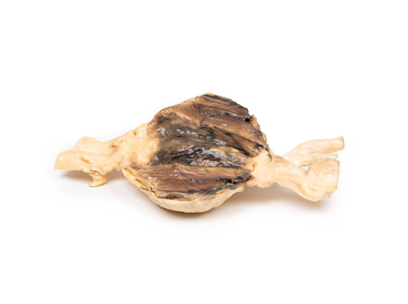 Abdominal aortaaneurisme