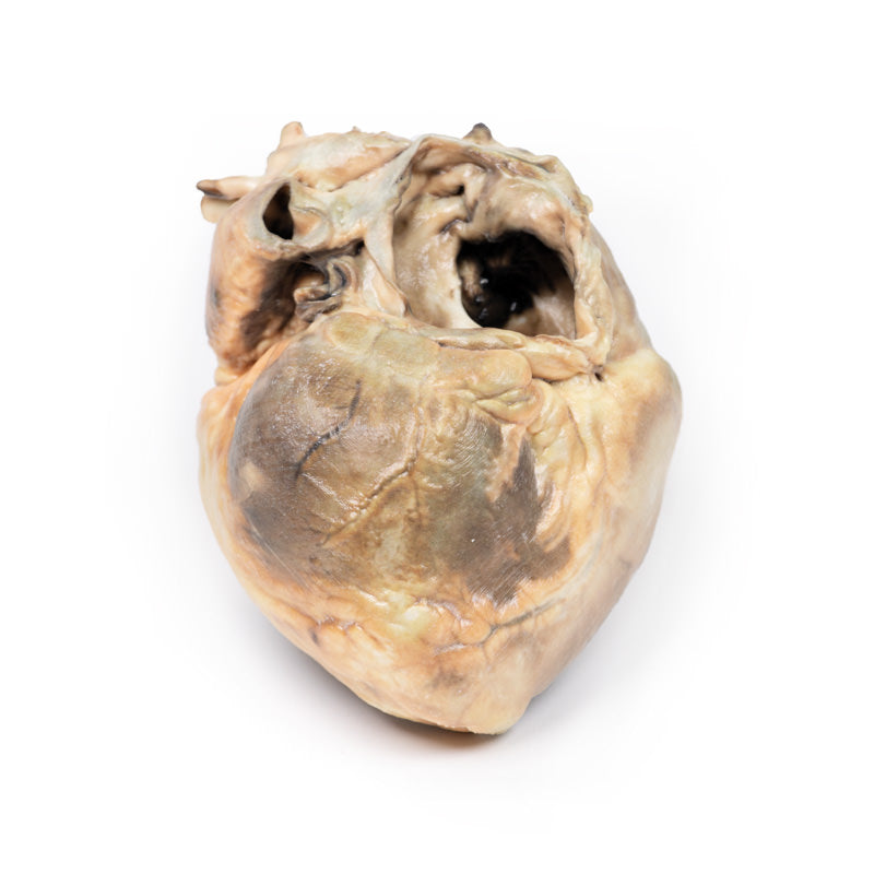 Atrial septal defekt