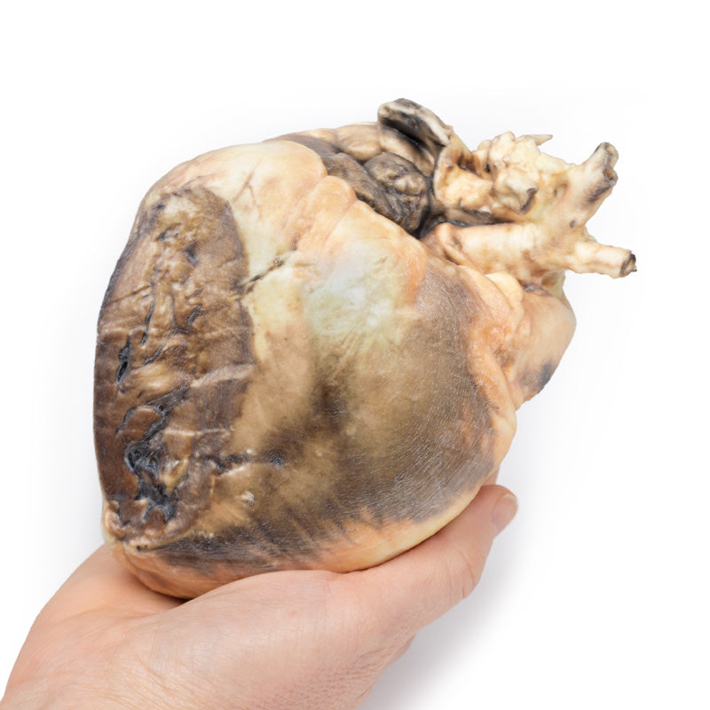 Atrial septal defekt