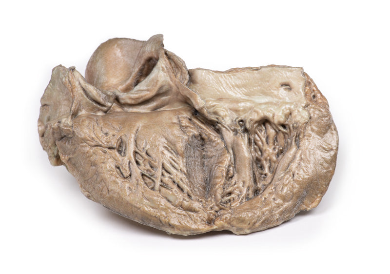 Bikuspidal aortaklap