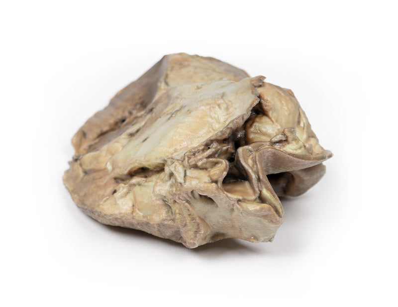 Bikuspidal aortaklap