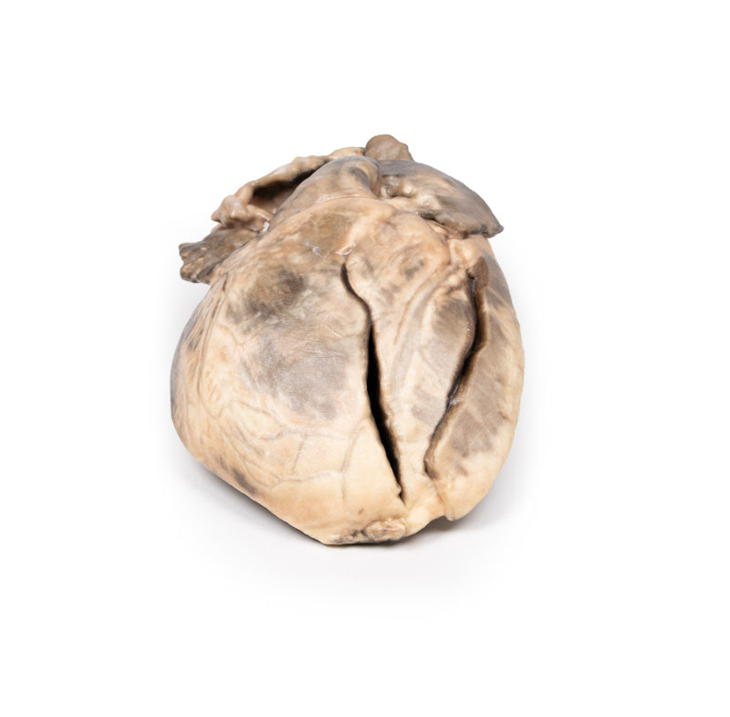 Hypertrofisk subaortastenose