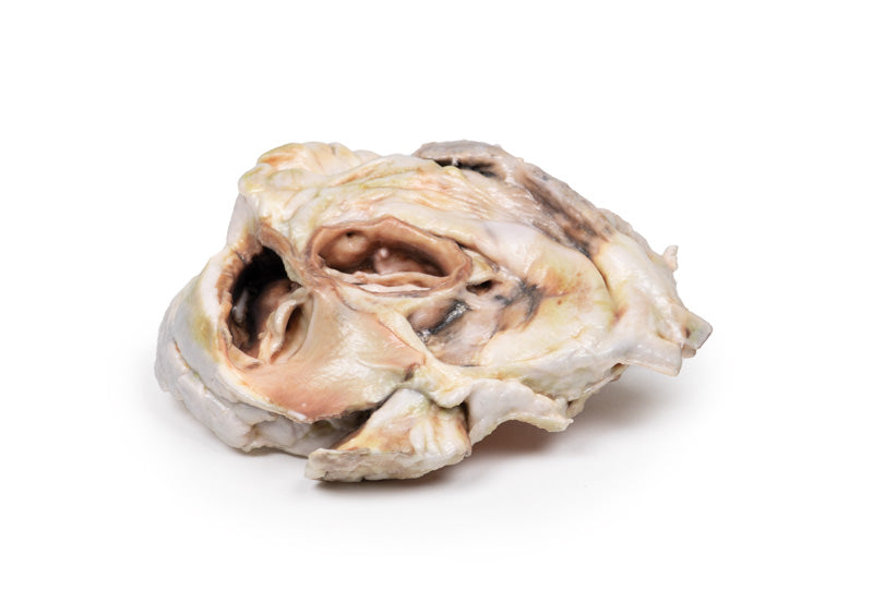 Forkalket aortaklapstenose Bikuspidal aortaklap