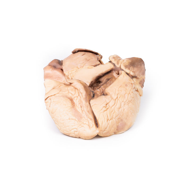 Reumatisk endocarditis