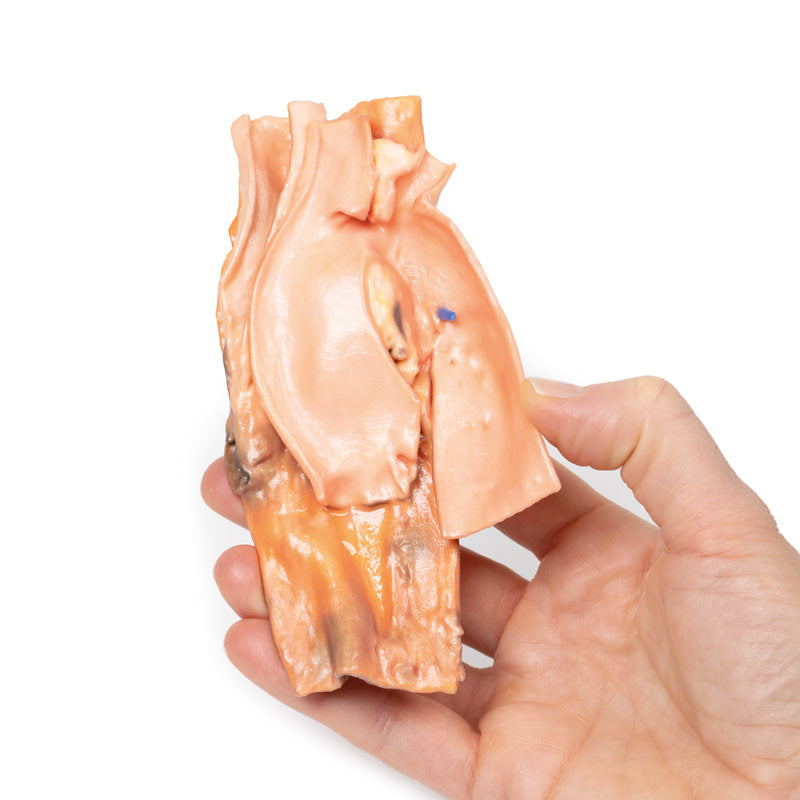 Traumatisk esophageal-aorta fistel