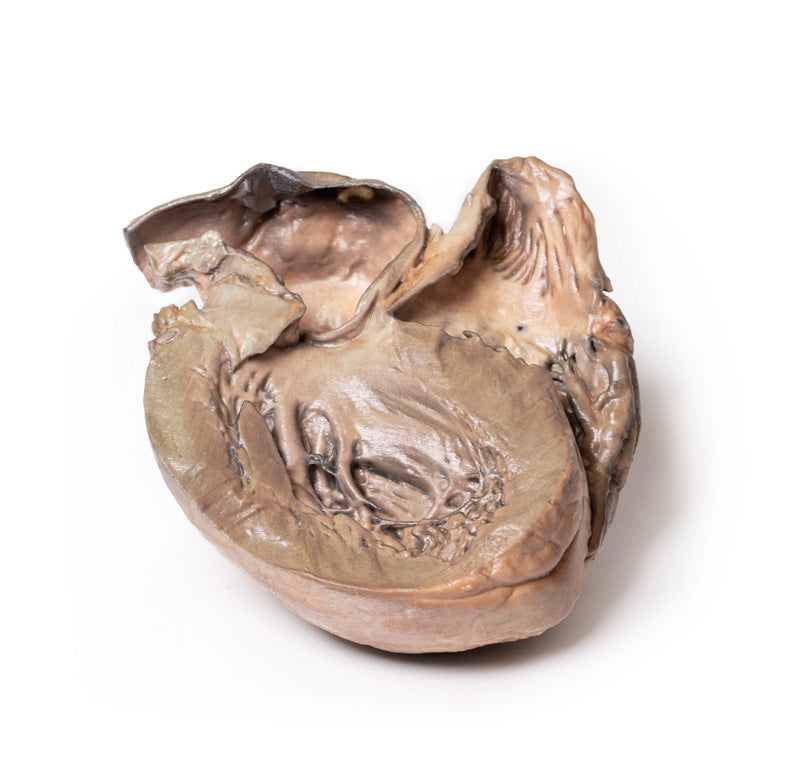 Brudt thorax aortaaneurisme