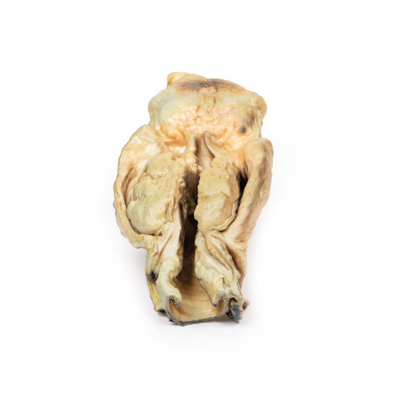 Carcinom i Larynx