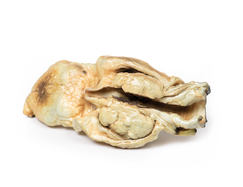 Carcinom i Larynx