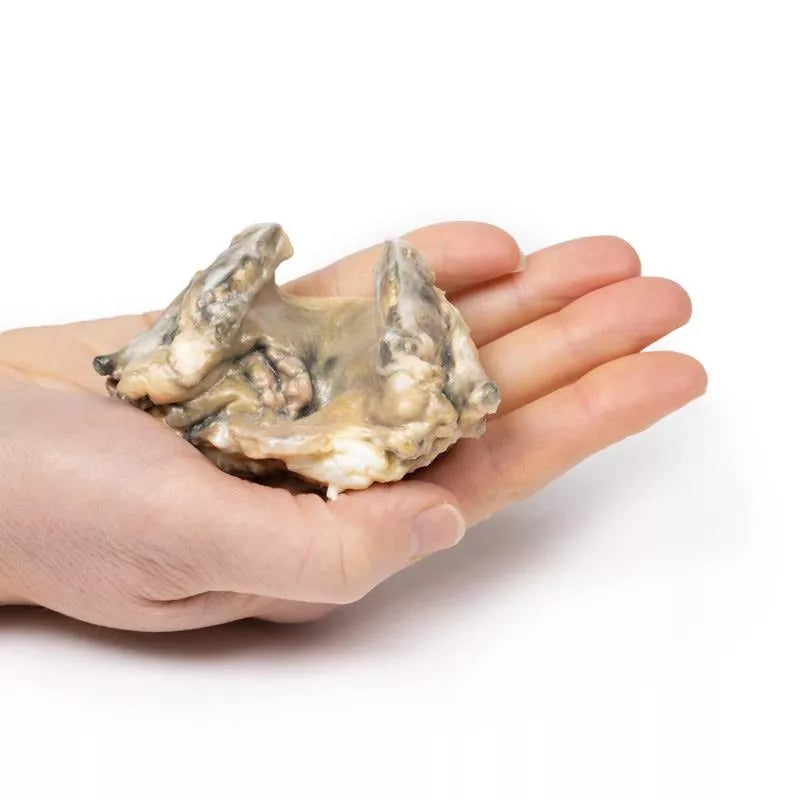 Carcinom i Larynx