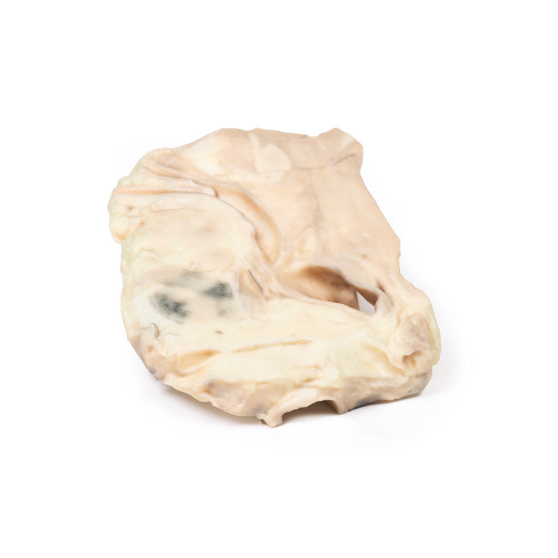 Luftrør – Hodgkins lymfom