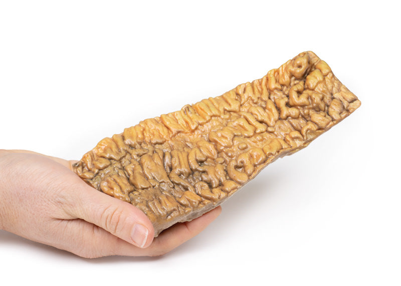 Colitis ulcerosa