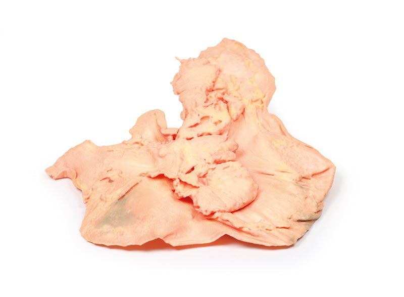 Adenocarcinom i maven