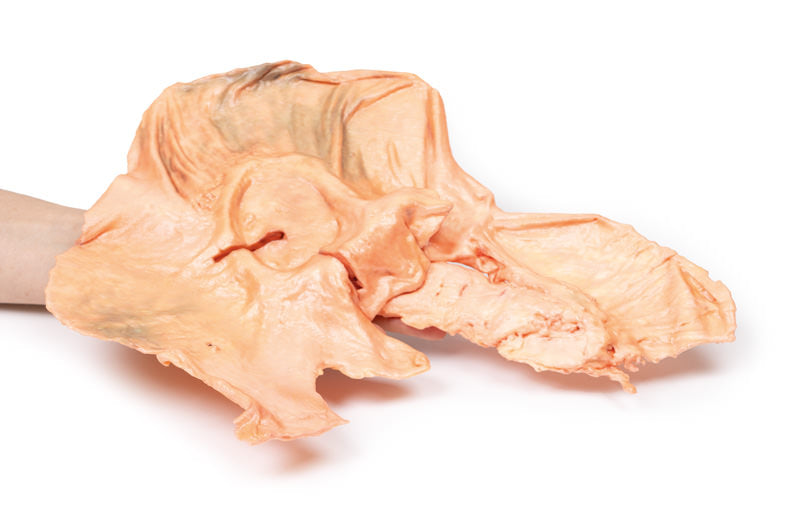 Adenocarcinom i maven