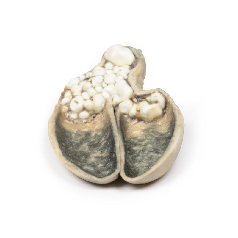 Kolecystitis og kolelithiasis
