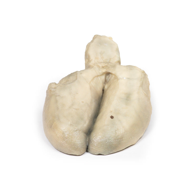 Kolecystitis og kolelithiasis