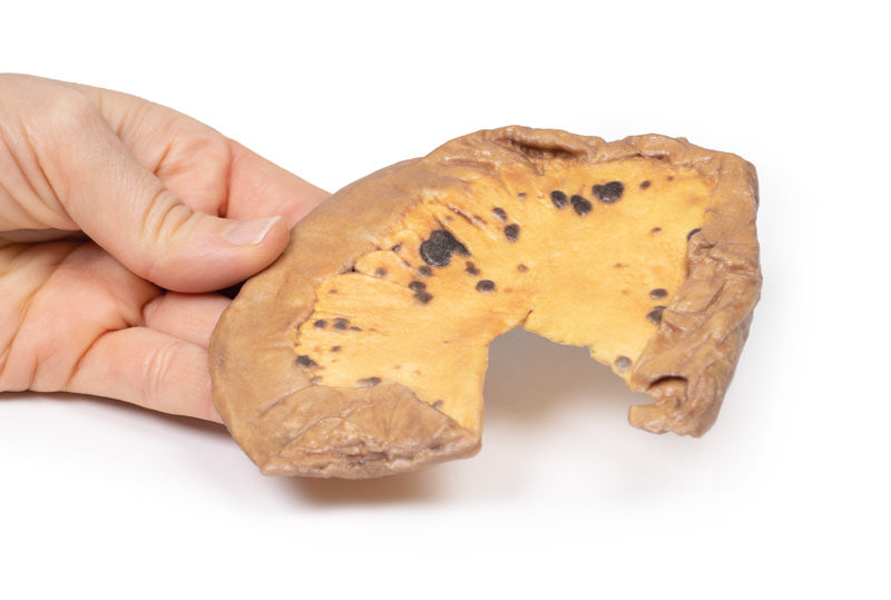 Mesenteriske metastaser fra kutan Maligna