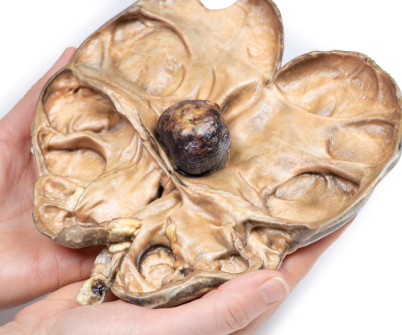 Hydronephrosis og Hydroureter forårsaget af obstruktion af en renal Calculus