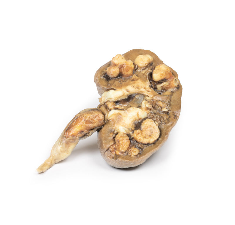 Flere renal calculi