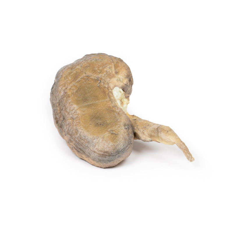 Flere renal calculi