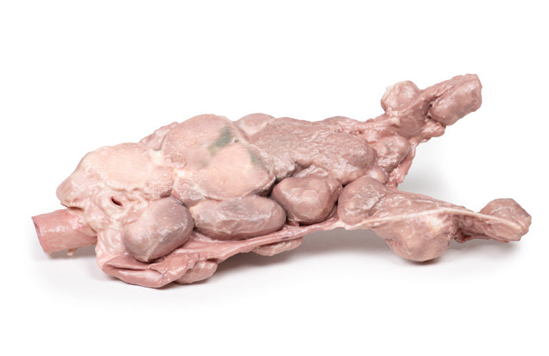 Aorta og para-aorta lymfeknuder