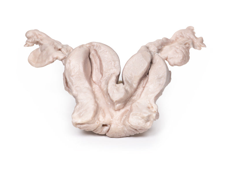 Uterus Bicornuate Unicollis