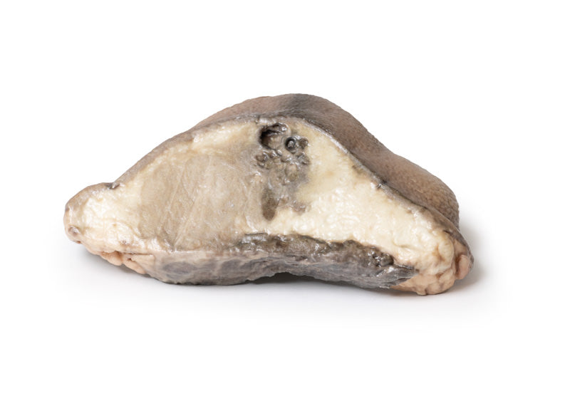 Carcinom i brystet