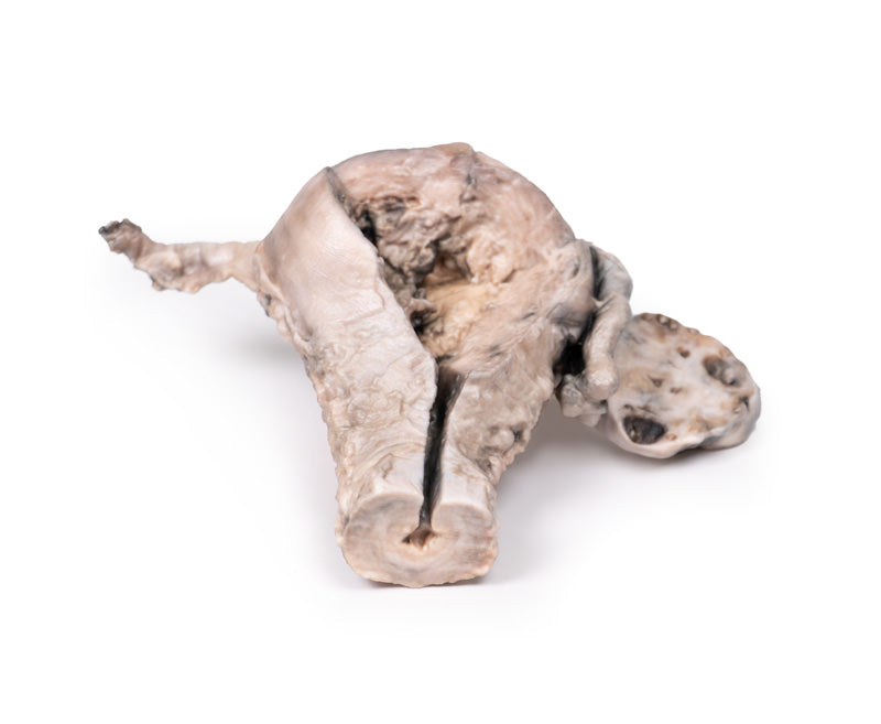 Endometriekarcinom
