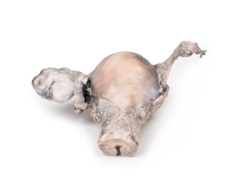 Endometriekarcinom