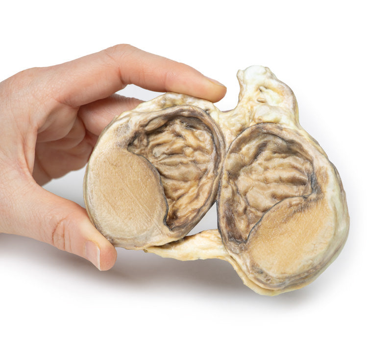 Kronisk hydrocoele