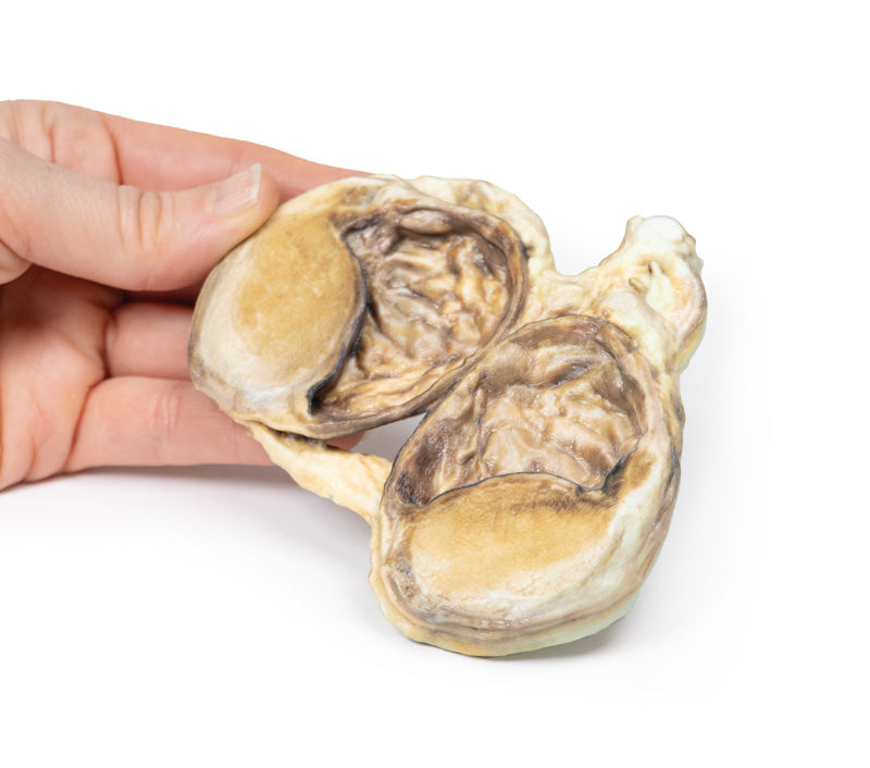 Kronisk hydrocoele