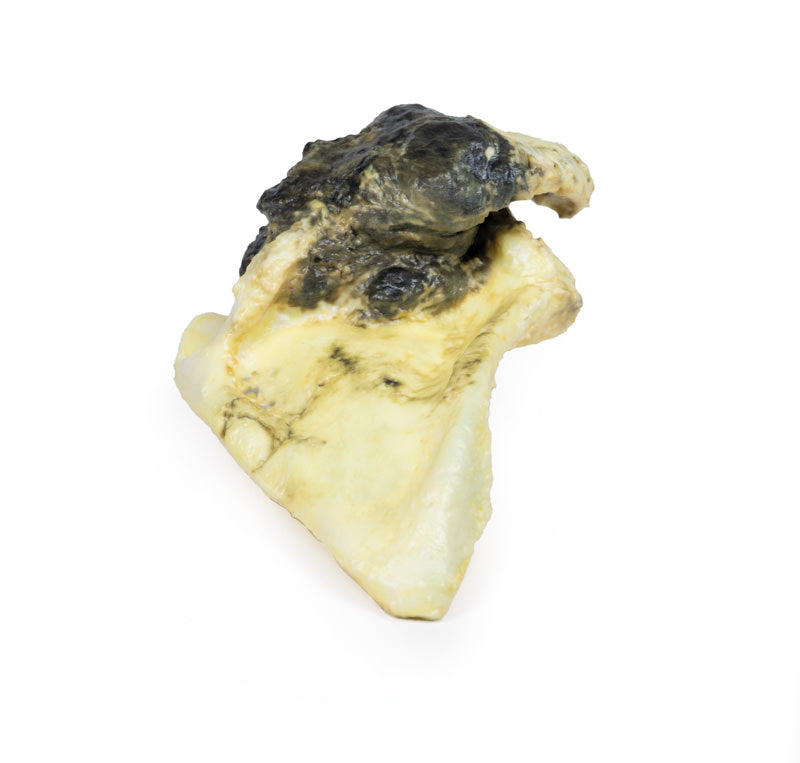 Chondrosarkom af scapula