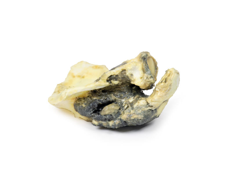 Chondrosarkom af scapula