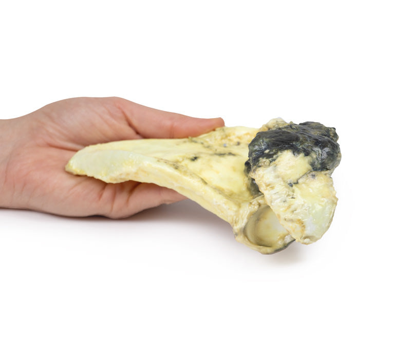 Chondrosarkom af scapula