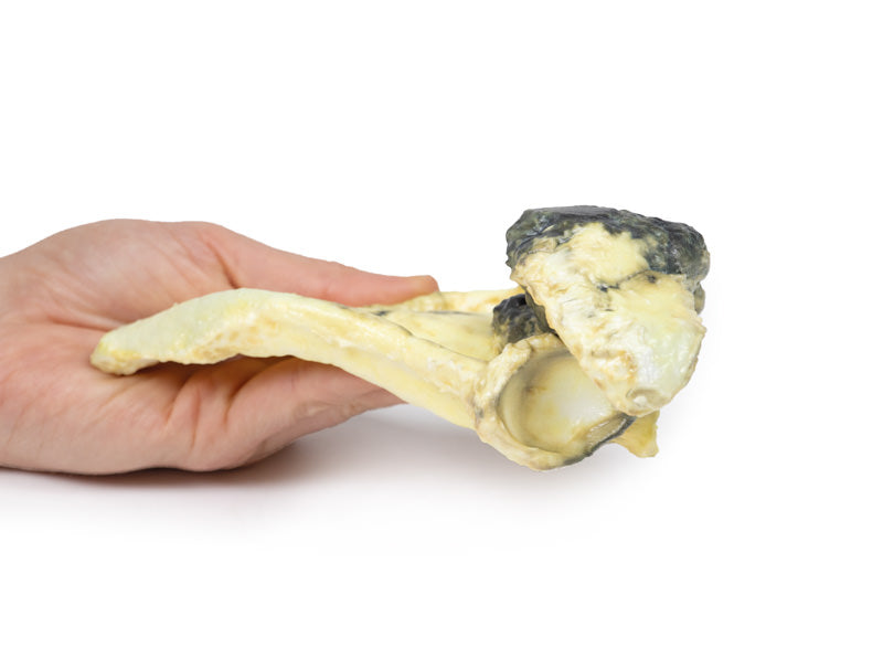 Chondrosarkom af scapula