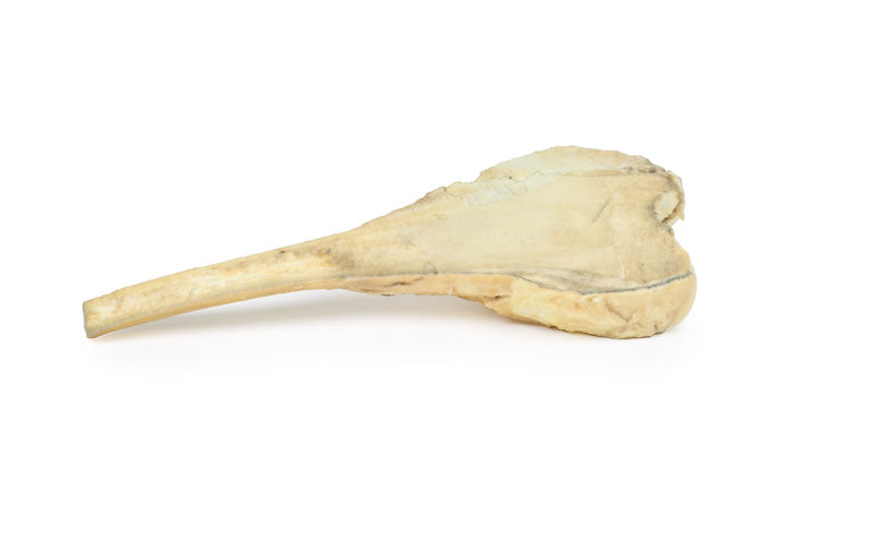 Osteosarkom af lårbenet