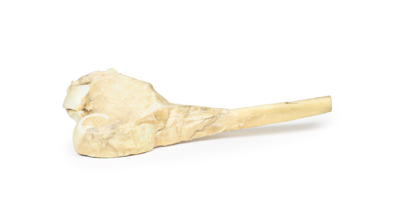 Osteosarkom af lårbenet