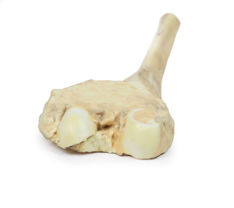 Osteosarkom af lårbenet