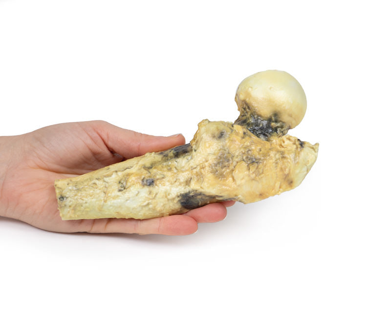 Osteosarkom af lårbenet