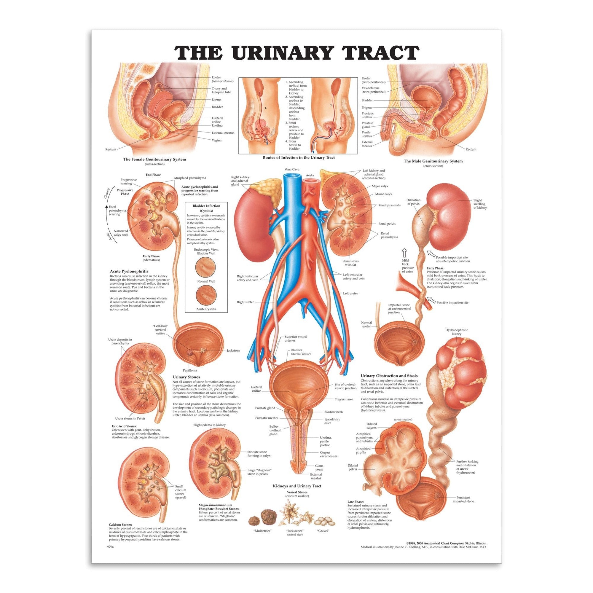 Plakat om nyren, urinvejene og relaterede sygdomme på engelsk - eAnatomi