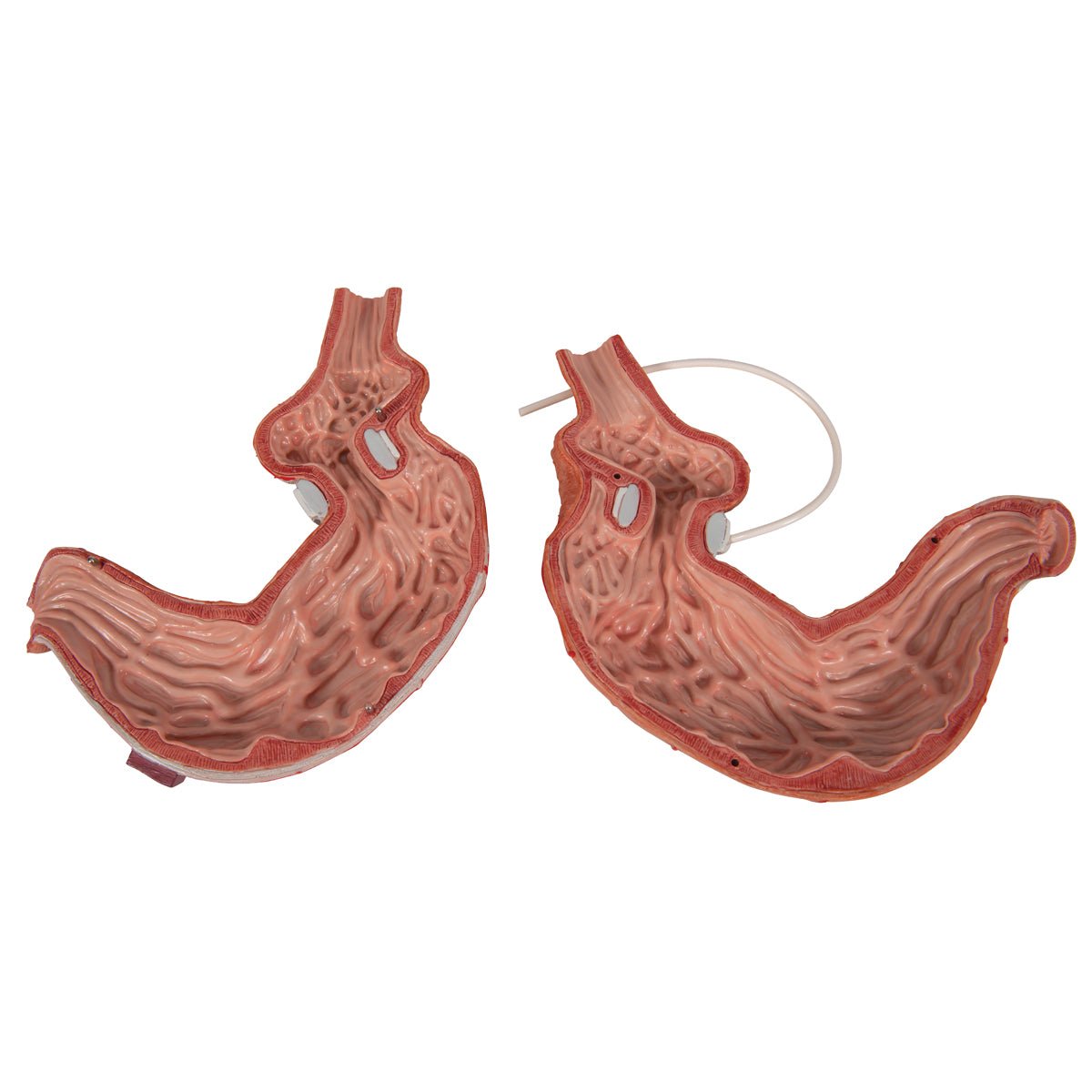 Mavesæk m. gastrisk banding - eAnatomi