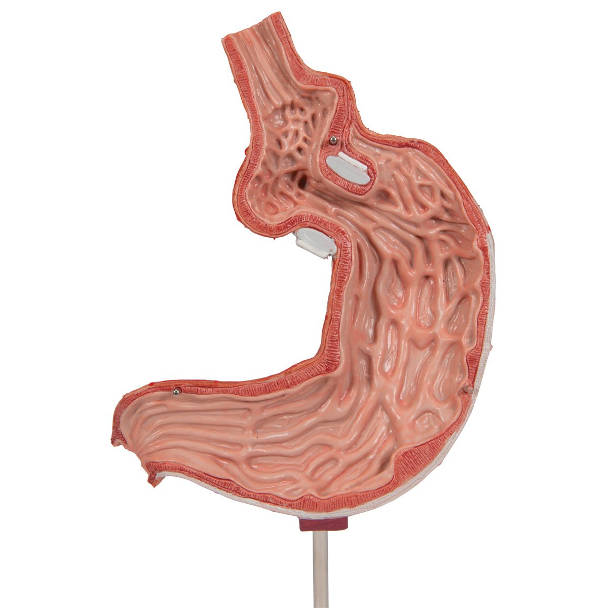 Mavesæk m. gastrisk banding - eAnatomi