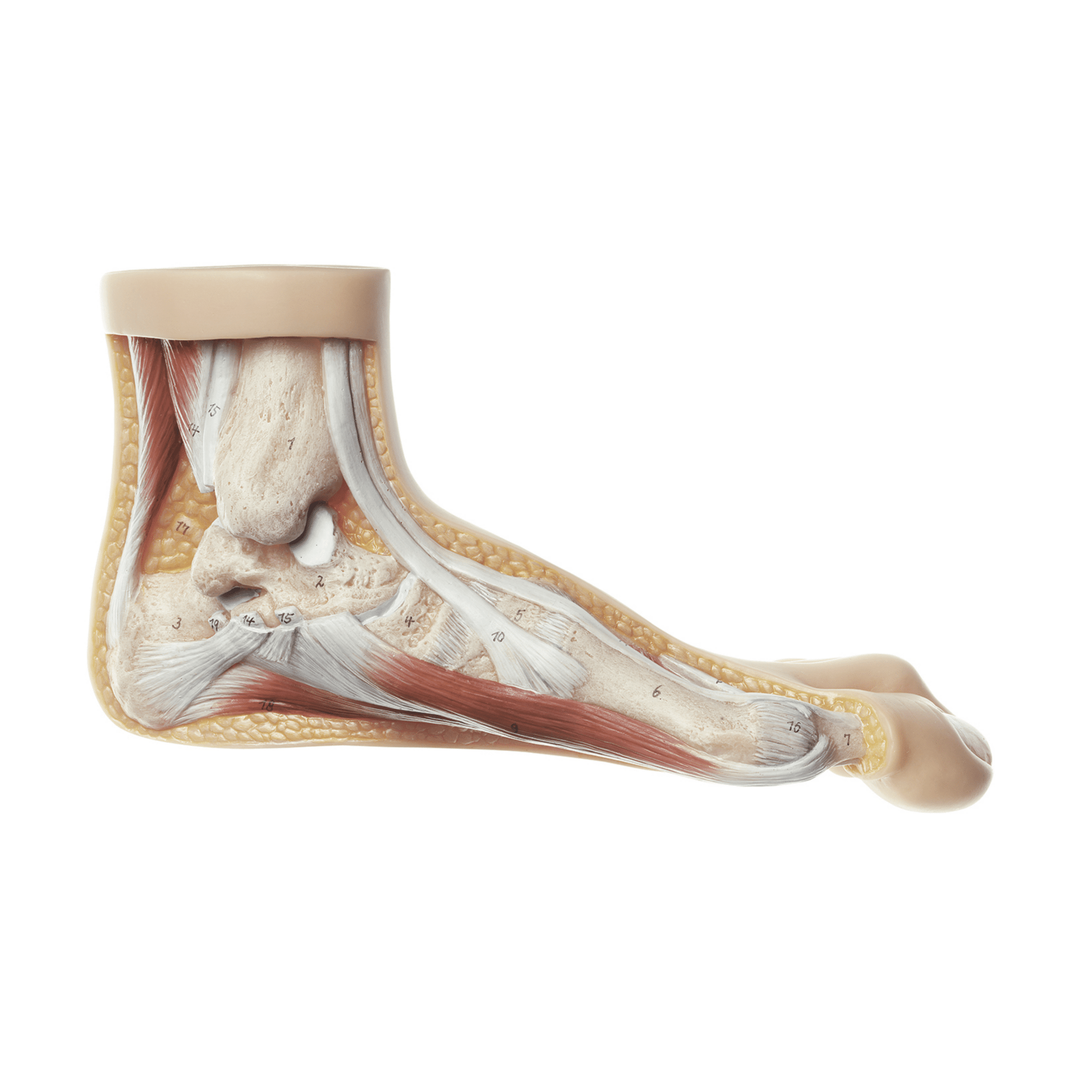 Fod m. hallux valgus - eAnatomi