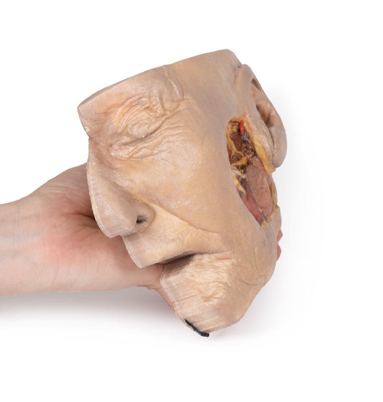Fridissektion af glandula parotidea og n. facialis - eAnatomi