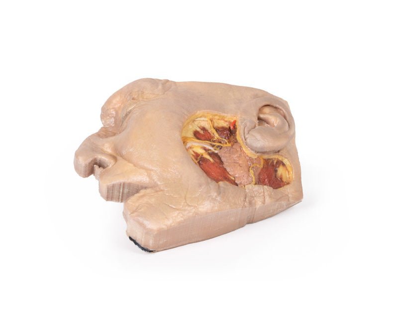 Fridissektion af glandula parotidea og n. facialis - eAnatomi