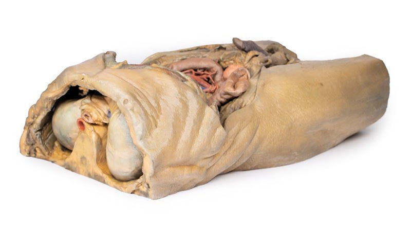 Abdomen m. bilaterale hernier - eAnatomi